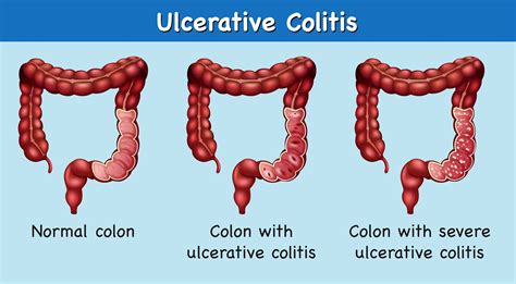 Diagram Showing Ulcerative Colitis 302827 Vector Art At Vecteezy