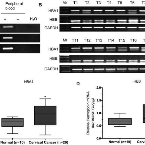 Elevated Expression Of Hba1 And Hbb In Human Cervical Cancer Tissues