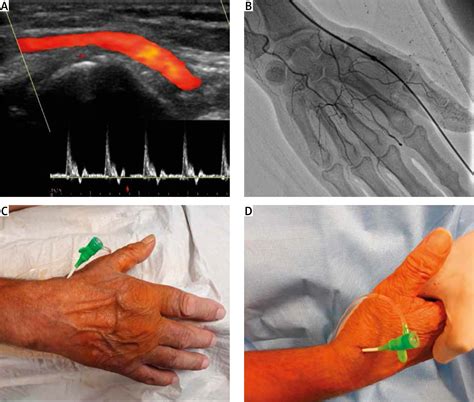 Coronary Intervention Via Novel Distal Radial Artery Approach