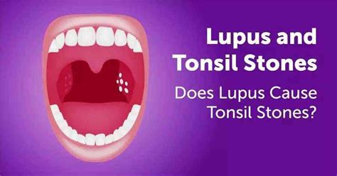 Discover Signs Causes Treatment And Prevention Tonsil Stones