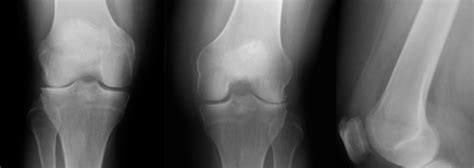 Nyc Knee Osteoarthritis Treatment Causes And Symptoms Of Knee