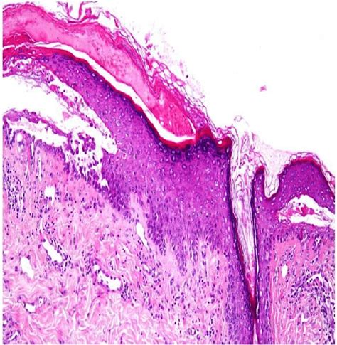 Suprabasal Acantholysis With Acantholytic Cell Hyperacanthosis And