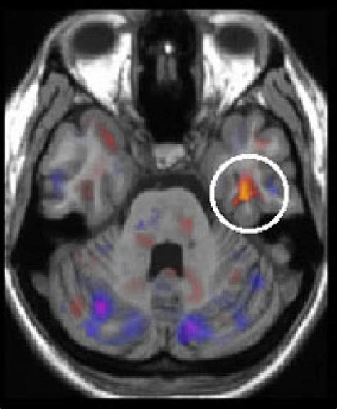 New Brain Scan For Diagnosing Schizophrenia Ucl News Ucl