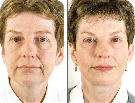 Dr Steven Denenbergs Facial Plastic Surgery Before And Afters Face