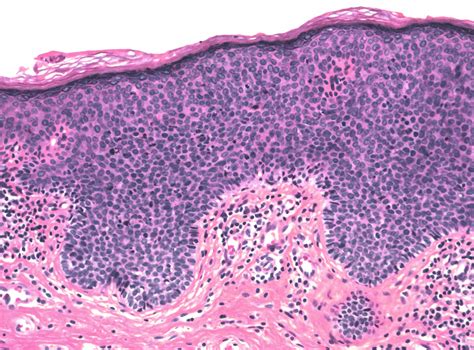 The Histopathology Of Vulvar Neoplasia GLOWM