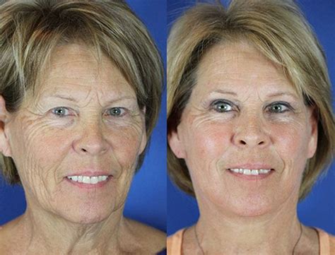 Before And After Facelift Photos Youthful Reflections Co2 Laser