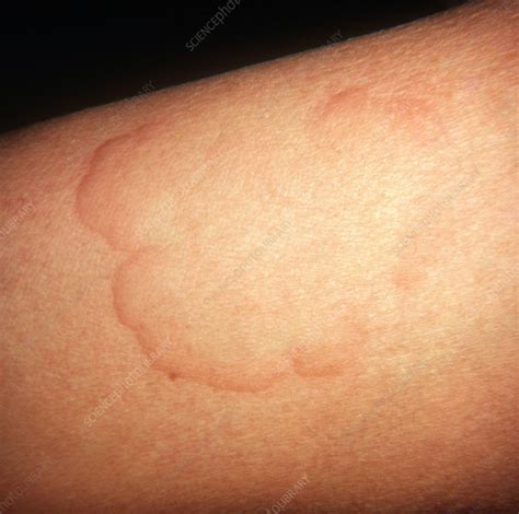 Urticaria Rash On The Skin Photograph By Dr P Marazzi