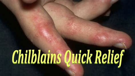 Chilblains Quick Relief Easy Home Remedy For Chilblains Cure For