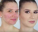 Makeup To Cover Acne Photos
