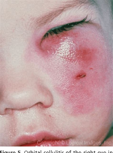 Pdf Differential Diagnosis Of The Swollen Red Eyelid Semantic Scholar