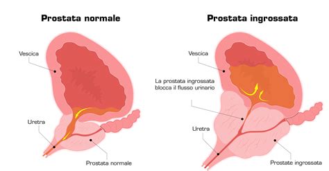 Iperplasia Prostatica Benigna Sintomi Gradi E Trattamento My Xxx Hot Girl