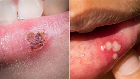 The best way to get rid of a cold sore scab is to let it heal on its own. How to Get Rid of a Cold Sore Fast. - YouTube