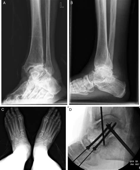 Total Ankle Replacement With Severe Valgus Deformity Technique And