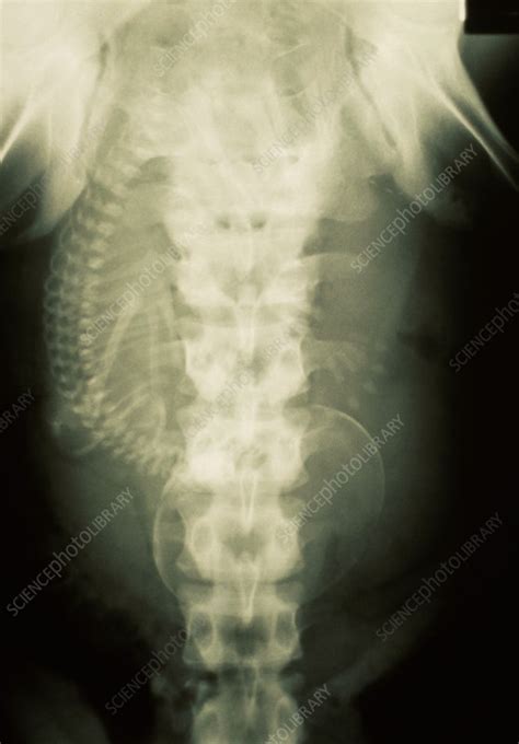 X Ray Of Abdomen Of A Pregnant Woman Stock Image P6800195