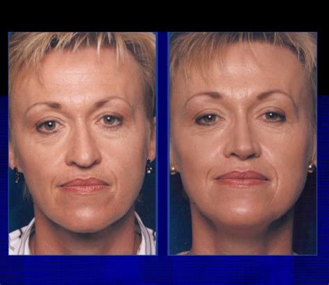 The Nose Clinic Before And After Nose Surgery Photos 10