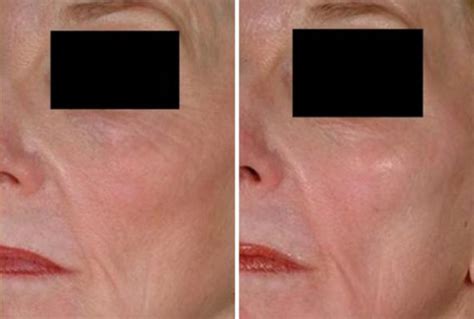 Laser Genesis Before And After Photo Gallery