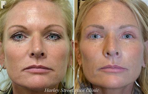 The Best Non Surgical Face Lift Options