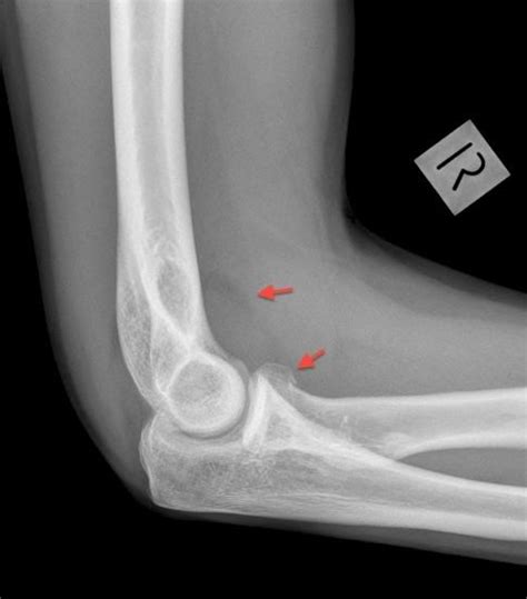 Sail Sign Elevation Of The Anterior Fat Pad On A Lateral Radiograph