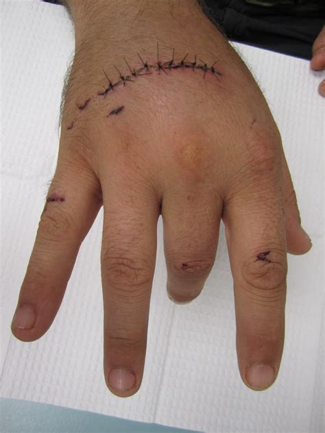 Extensor Tendon Injury In Hand