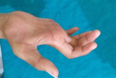 Figure Complete Claw Hand Contributed By Sunil Munakomi Md
