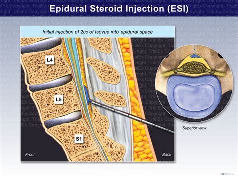 Epidural Steroid Injection Esi Trialexhibits Inc