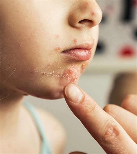 Hand Foot And Mouth Disease Adults Face