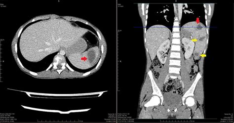 Cureus Hydatid Cyst Of Spleen Presenting With Vague Symptoms A