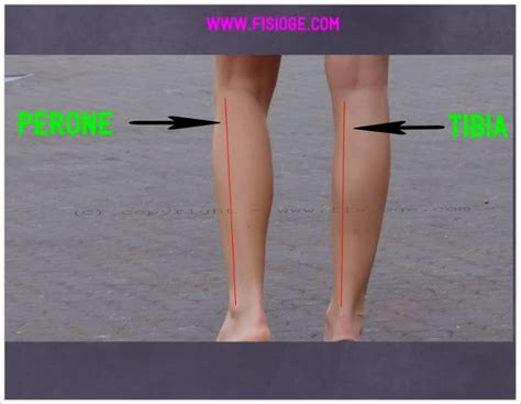 FISIOTERAPIA DOPO FRATTURA DI TIBIA E PERONE