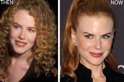 Nicole Kidman Then And Now Hair Implants Plastic Surgery Nicole