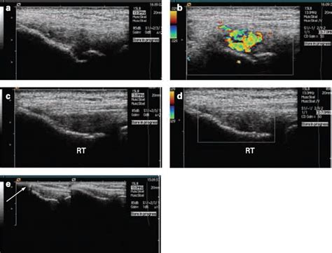 A Two Year Sonographic Follow Up After Intratendinous Injection Therapy