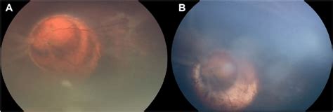 Fundus Photographs Of The Left Eye In Case 2 Showing Partial Retinal