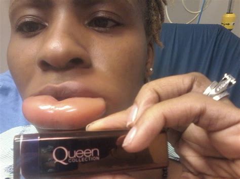 Woman Gets With Swollen Lips After Using A Dubious Lipstick Before And After Photos Gistmania