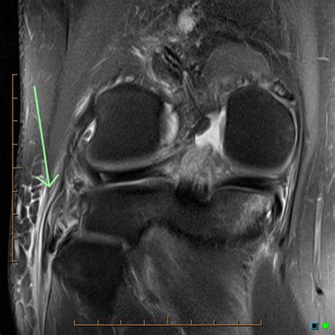 Posterolateral Corner Injury Of The Knee Pacs