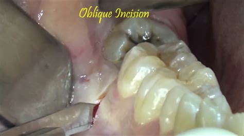 Decayed And Partially Erupted 3rd Molar Extraction Surgical Video Youtube