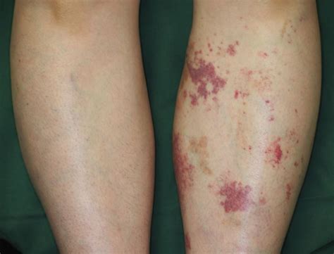 Le macchie compaiono soprattutto su mani, piedi e collo e una volta che compaiono è. Porpora malattia - Dermatiti - Macchie cutanee
