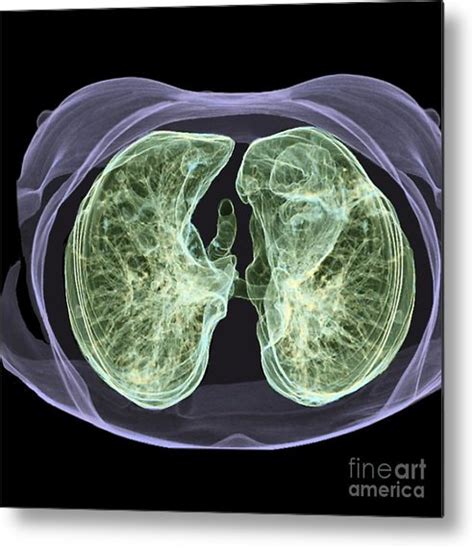 What Do Healthy Lungs Look Like On A Ct Scan Bronchitis Contagious