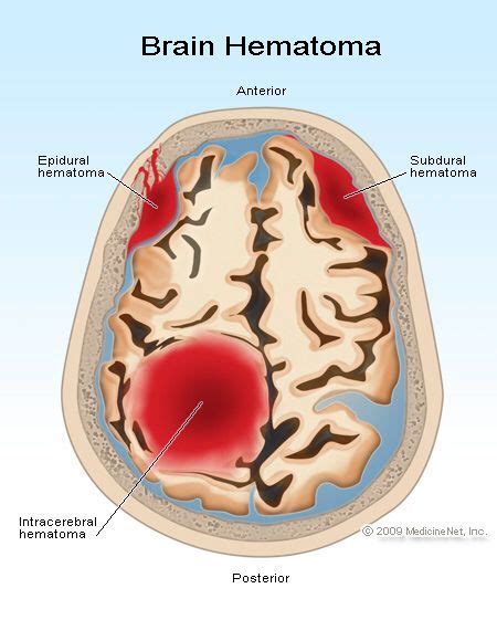 Epidural Subdural And Intracerebral Hematoma Brain Hemorrhage