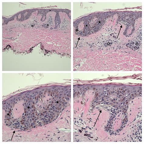 Cureus Linear Malignant Melanoma In Situ Reports And Review Of