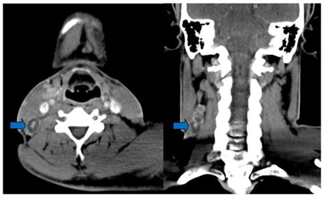 Axial And Coronal Contrasted Ct Of The Neck Shows A Well Defined