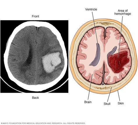 Brain Avm Arteriovenous Malformation Disease Reference Guide