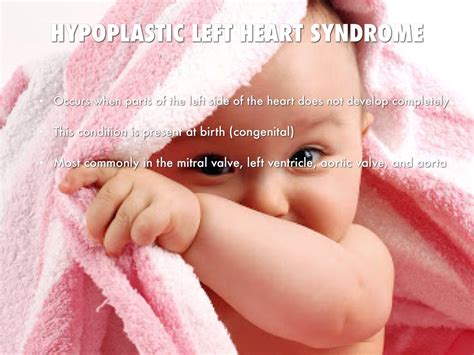 Hypoplastic Left Heart Syndrome By Ashley Flippo