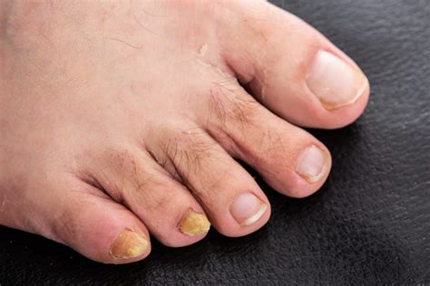 Etliche inder verloren aufgrund der infektion bereits ihre augen. Kolloidales Silber bei Nagelpilz: Wirksam oder gefährlich?