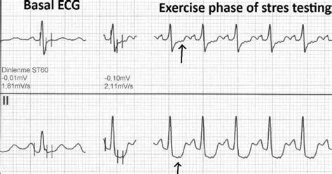 Exercise Induced Atrial Repolarization Ta Wave American Journal Of