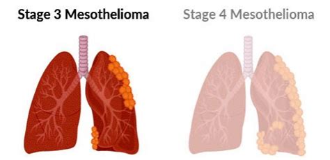 Stage 3 Mesothelioma Survival Rate Symptoms And Treatment
