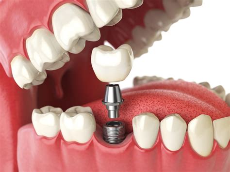 More About Dental Implants Advanced Arts Denture Center Plus In York Pa