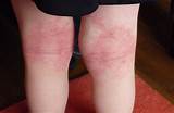 Eczema On Back Of Knees Treatment Images