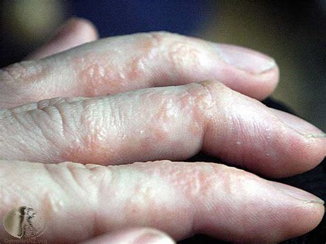 Dyshidrotic Eczema Fingers Dorothee Padraig South West Skin Health Care