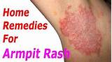 Photos of Staph Infection Boils Home Remedies