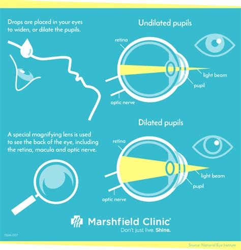 Seeing The Benefits Of Dilated Eye Exams Shine365 From Marshfield Clinic