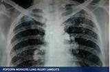 Popcorn Lung Chemical Photos